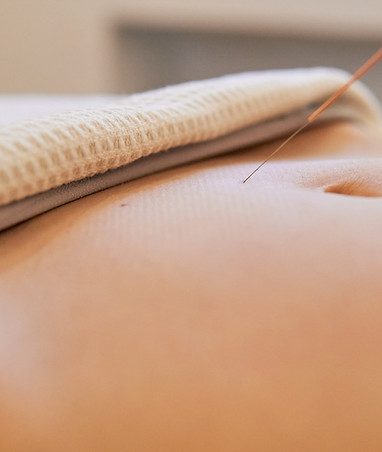 Close-up of a hair-thin acupuncture needle being placed